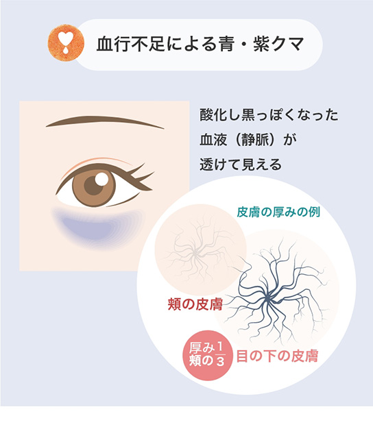 血行不足による青・紫クマ　酸化し黒っぽくなった血液（静脈）が透けて見える　目の下の皮膚は頬の1/3