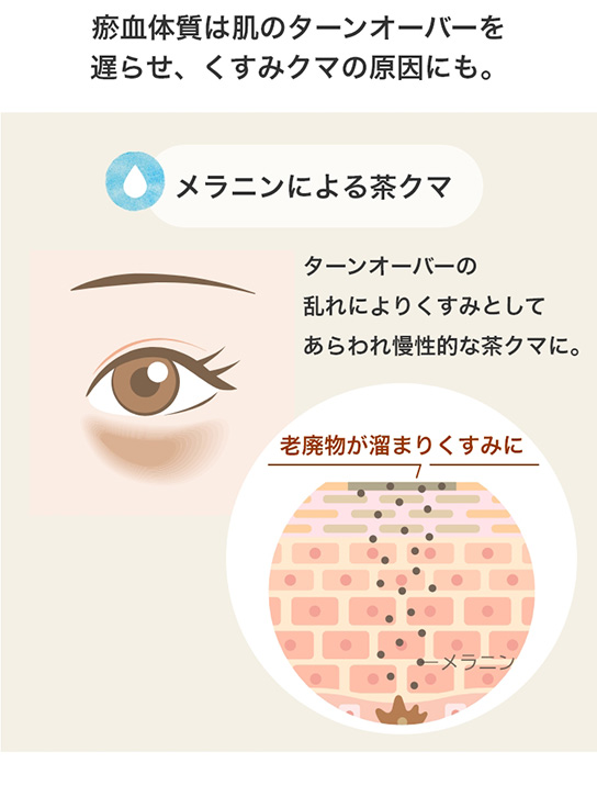 瘀血体質は肌のターンオーバーを遅らせ、くすみクマの原因にも。メラニンによる茶クマ ターンオーバーの乱れによりくすみとしてあらわれ慢性的な茶クマに。老廃物が溜まりくすみに